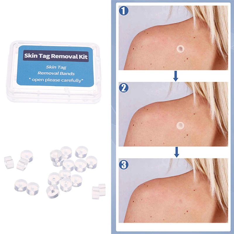 20pcs Micro Rubber Band Skin Tag Remover – Non-Toxic Kit Skin Tag Remover PLUSH