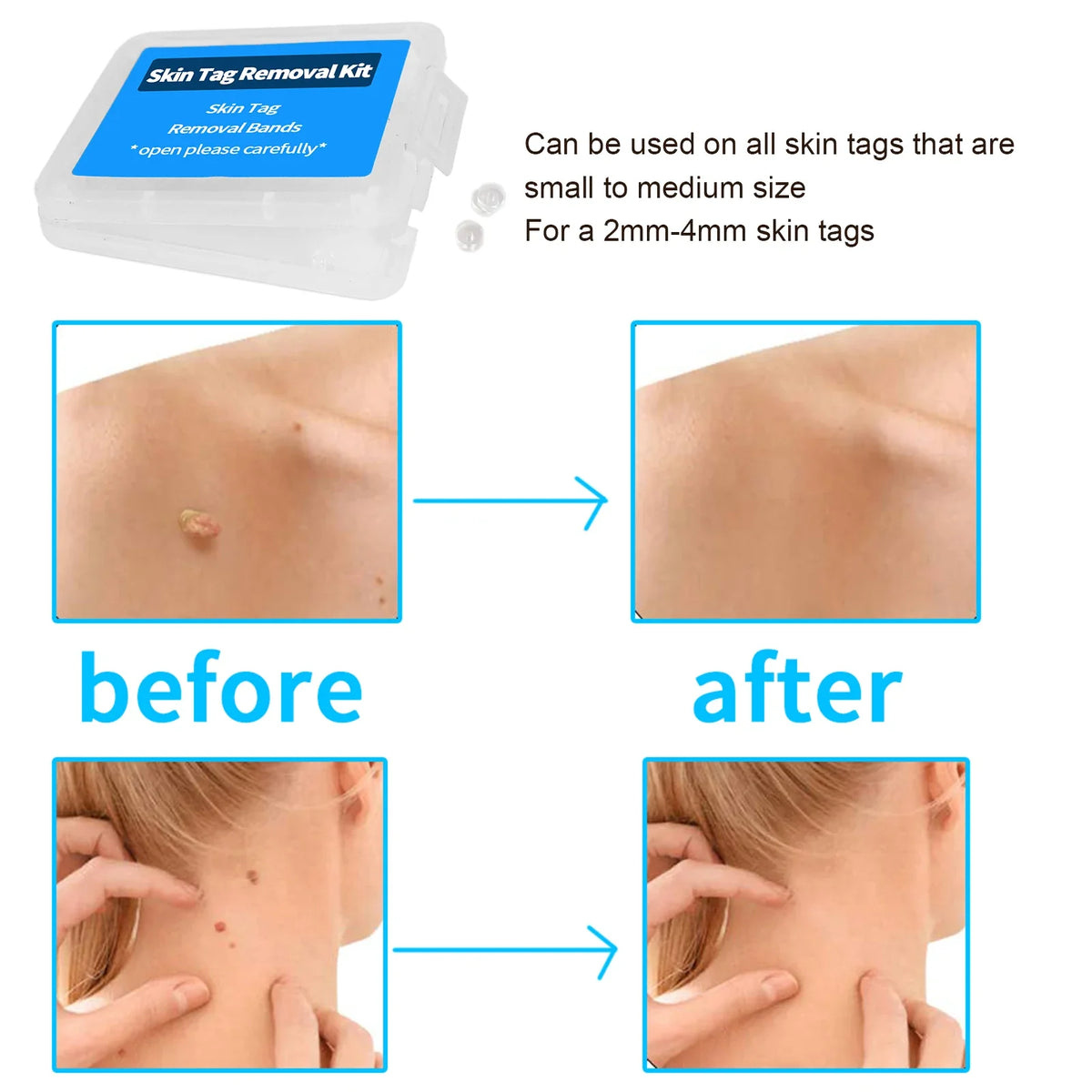 Skin Tag Removal Bands 30pcs – Non-Toxic Rubber Rings Skin Care Tool PLUSH